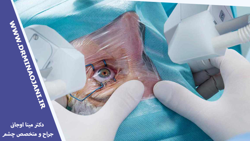 مزایای جراحی آب مروارید زودرس – متخصص چشم پزشکی در کرج